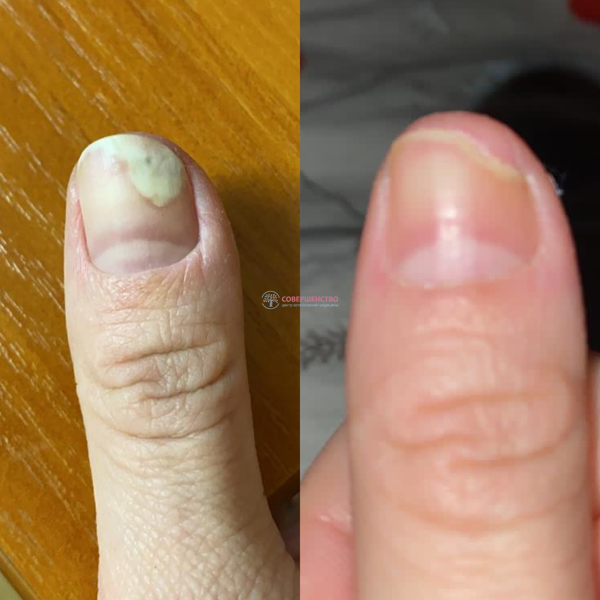 Грибок ногтей — причины, симптомы и способы лечения | Клиника Биляка